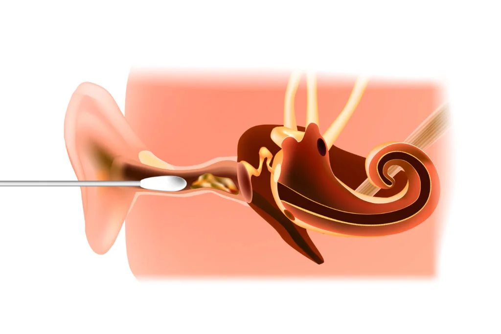 Microsuction ear wax removal in clinic by a trained professional at Everything Ears.